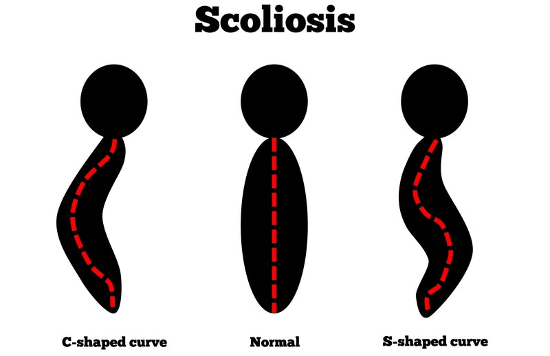 Fairview Park, OH scoliosis treatment